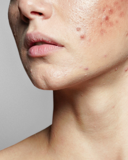 acne Skin