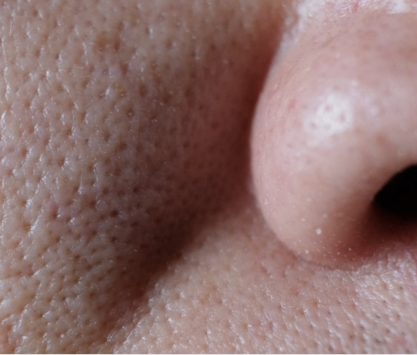 Enlarged And Open Pores - The Ogee Clinic