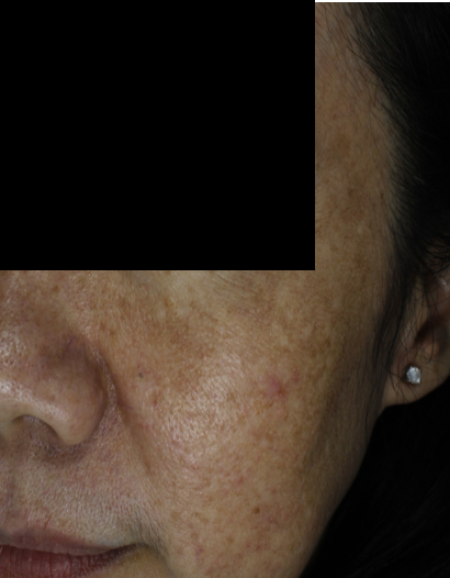 Melasma Skin Pigmentation