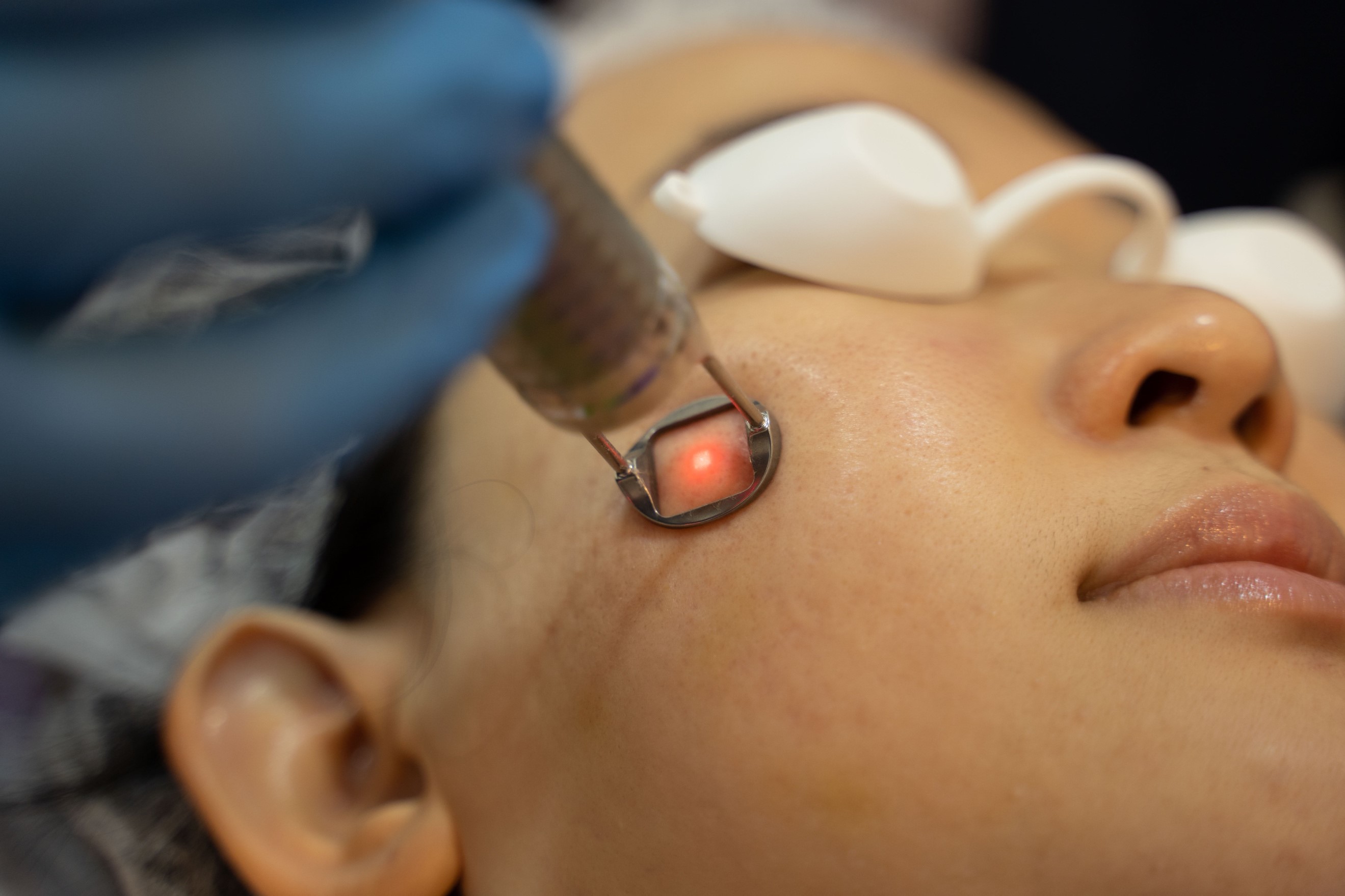 Laser treatment for melasma deals