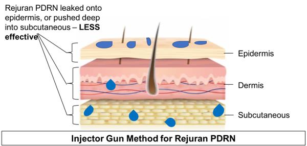 visual illustration of injector gun method for rejuran pdrn