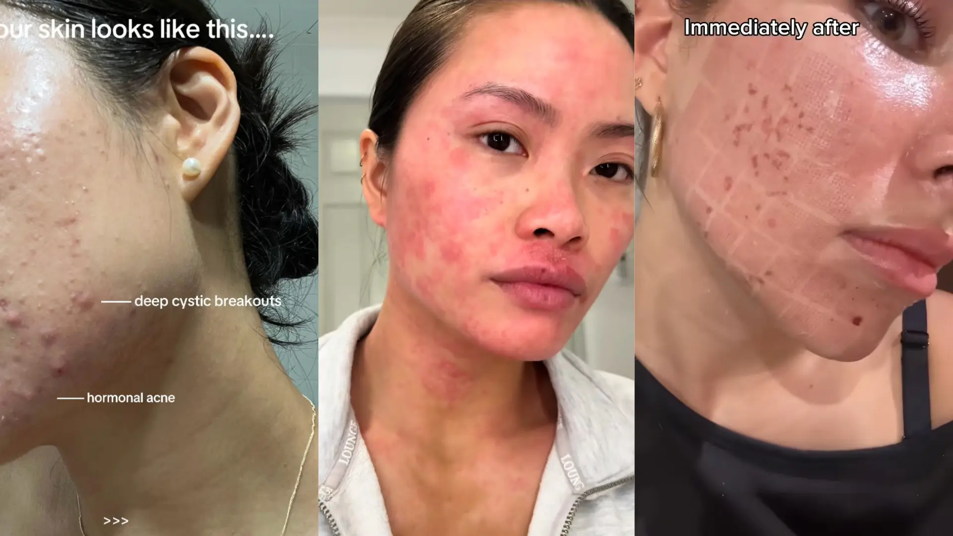Skin Boosters for Acne Scars