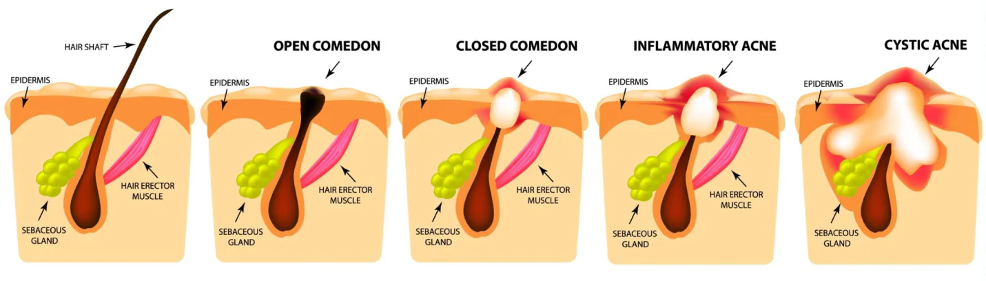 Acne formation