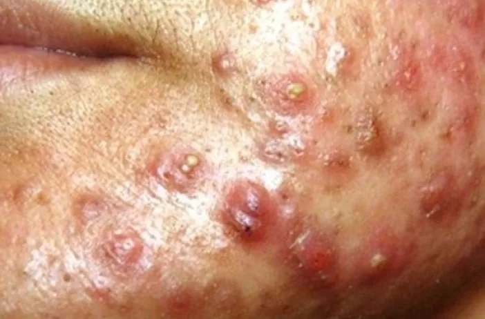 Keloid scars