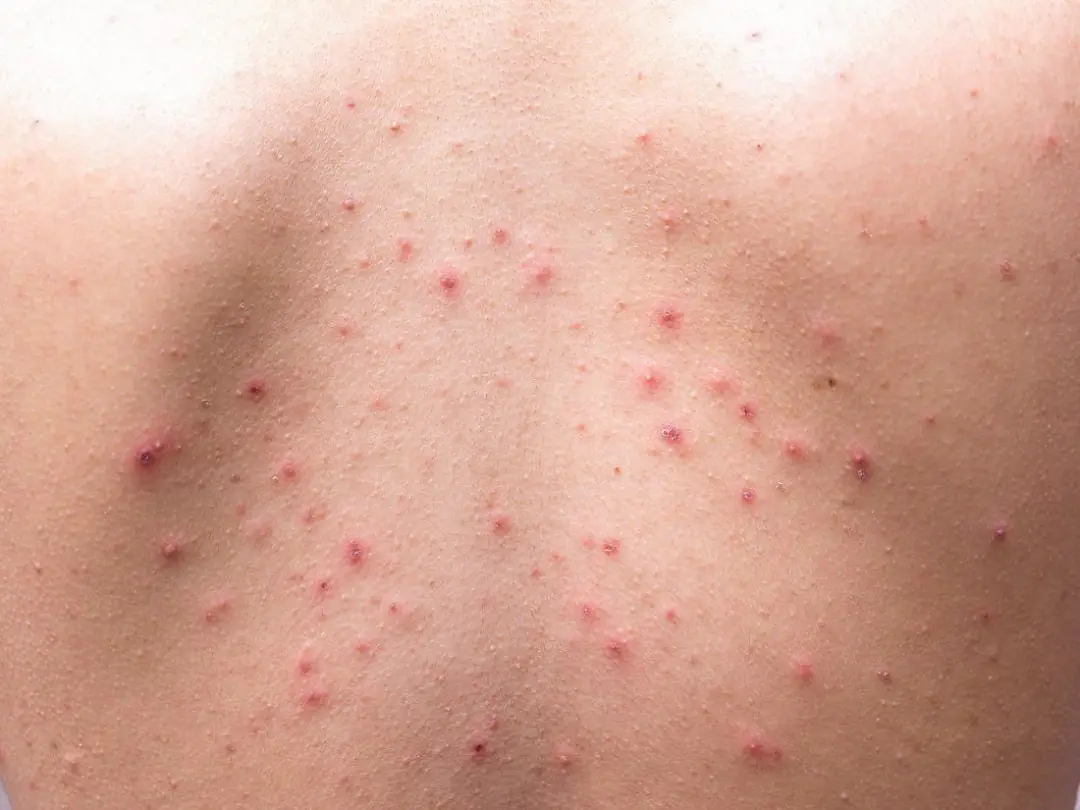 Acne Skin on Body