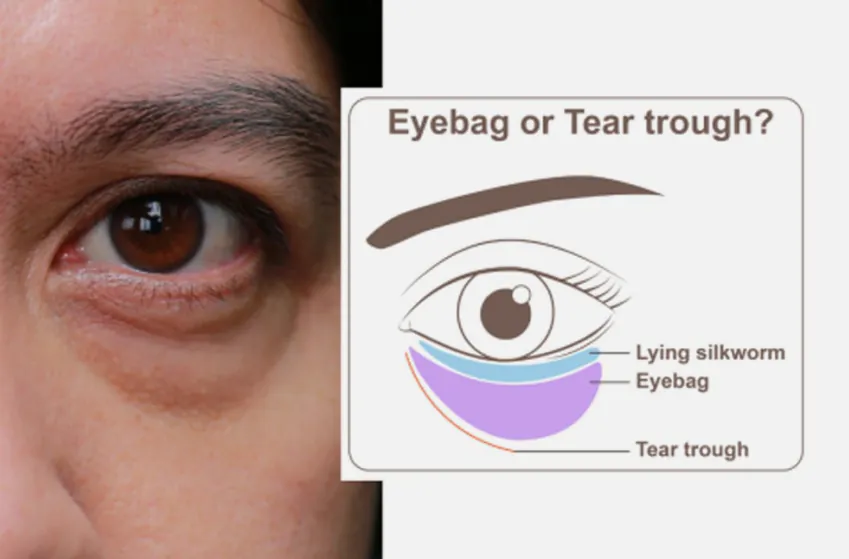 Dark eye circle treatment Singapore
