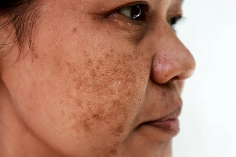 Skin problem, Closeup skin face asian women with spot melasma.