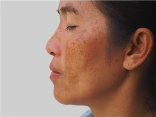 Melasma