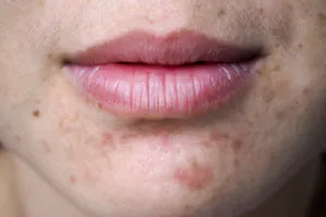 Post inflammatory hyperpigmentation (PIH)