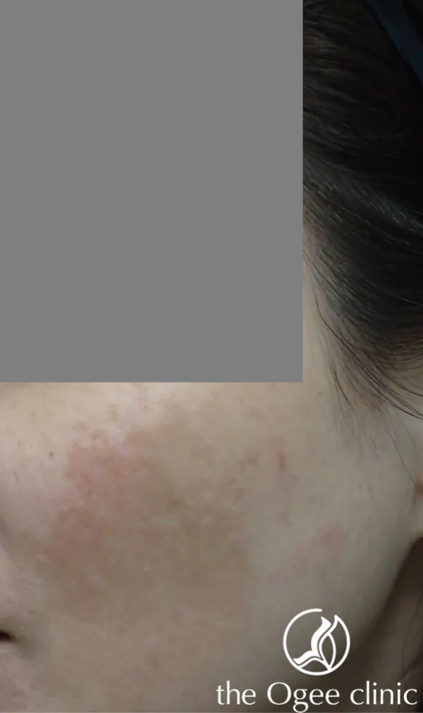 Recalcitrant melasma 1