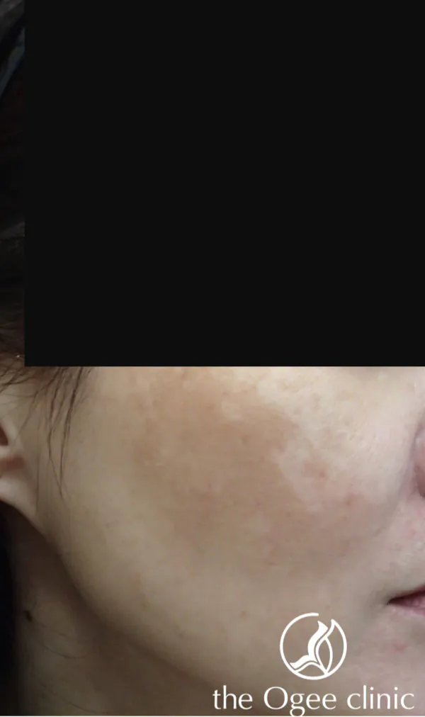 Recalcitrant melasma 2