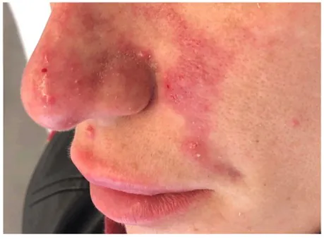 Skin necrosis after filler injection