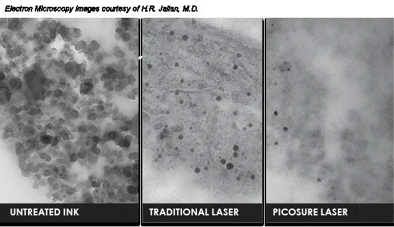 Types of Laser Treatment