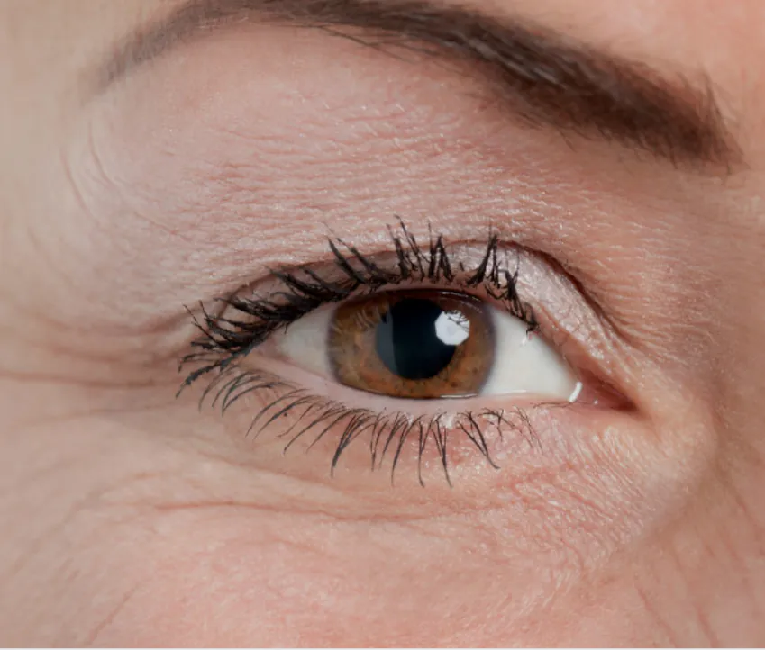 Wrinkles And Fine Lines