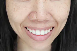 Freckles