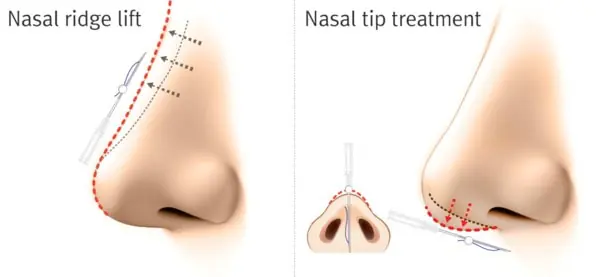 graphic illustration of a nose lift