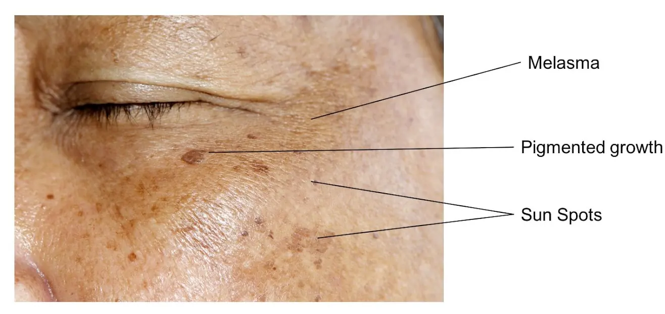 Why is Pigmentation Such a Growing Concern in India?
