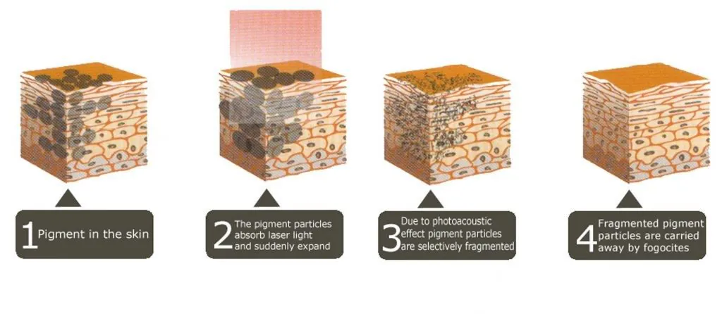 Effects of laser treatment on skin pigmentation
