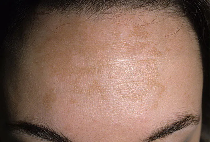 Melasma is a type of hyperpigmentation