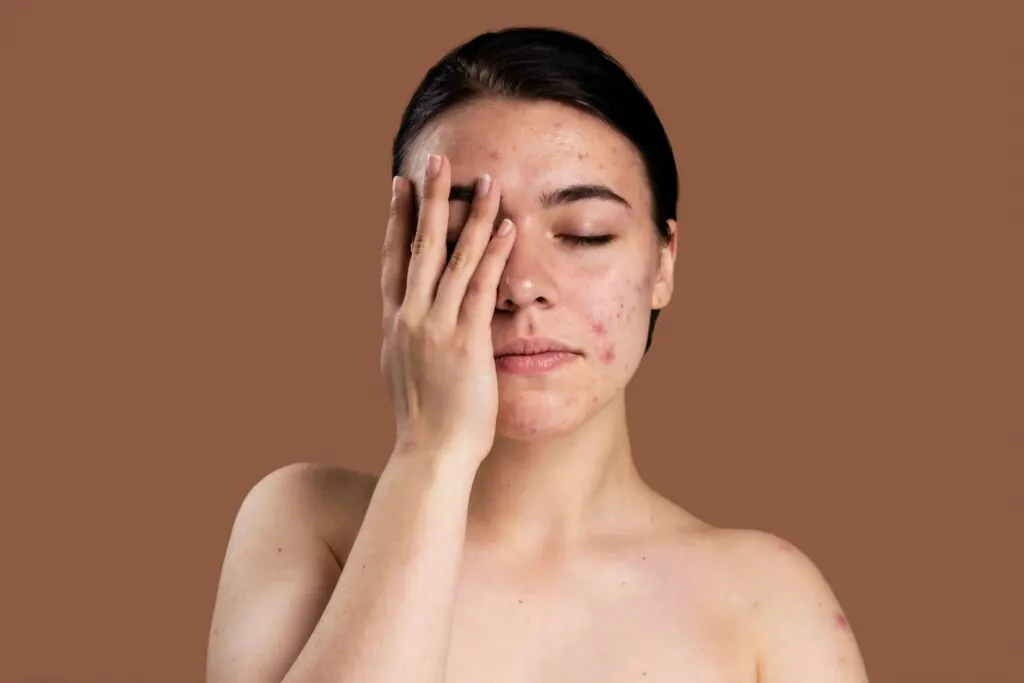 Hormonal factors influencing melasma infographic