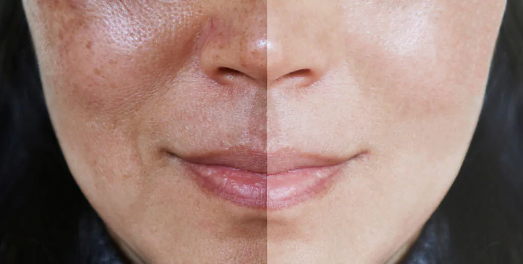 Before and after gradual improvement from melasma therapy