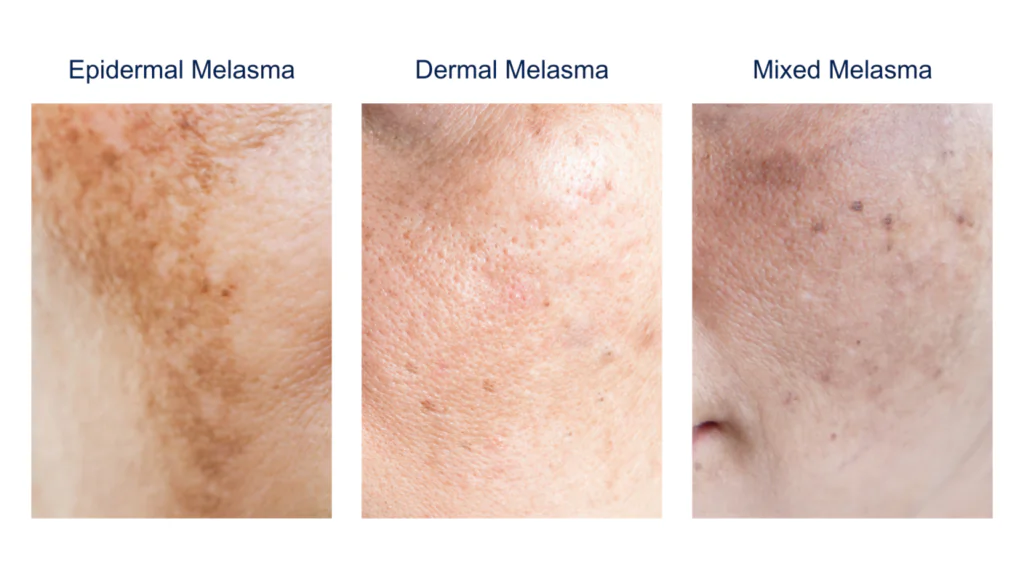 Diagram of melasma skin types (epidermal, dermal, mixed)