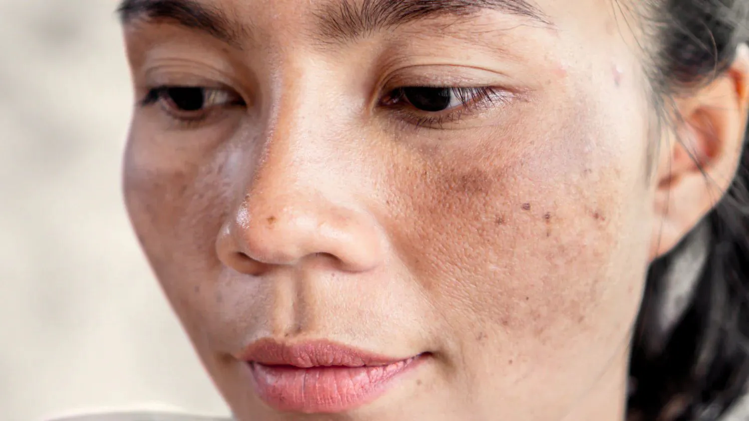 Melasma Treatment
